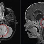 Medulloblastoma, nuove speranze di cura dal Bambino Gesù