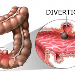 Malattia diverticolare: la dieta