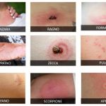 Punture da ape, zanzara, cimice e zecche: cosa fare e come distinguerle