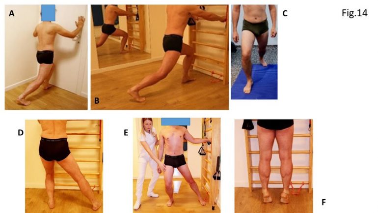 Trattamento riabilitativo post-operatorio delle fratture pertrocanteriche del femore 3