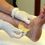 Opi la Spezia: una borsa di studio per il Master sulla cura e assistenza delle lesioni cutanee