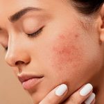 Acne giovanile: l'impatto degli ormoni e le possibili cure