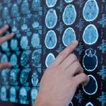 Emorragia intracerebrale, l'acido tranexamico non riduce la crescita dell'ematoma