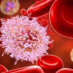 Leucemia linfoide acuta: completa remissione con l’utilizzo di cellule Car-T