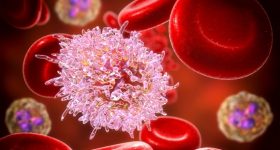 Leucemia linfoide acuta: completa remissione con l’utilizzo di cellule Car-T
