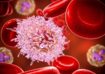 Leucemia linfoide acuta: completa remissione con l’utilizzo di cellule Car-T