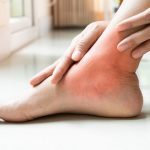Piede diabetico: innovativa terapia cellulare autologa per ridurre amputazioni