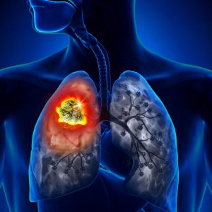 Un nuovo studio di screening del cancro al polmone ha ottenuto una riduzione della mortalità del 35%