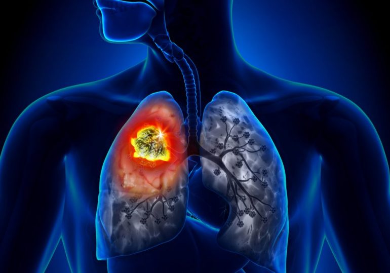 Un nuovo studio di screening del cancro al polmone ha ottenuto una riduzione della mortalità del 35%