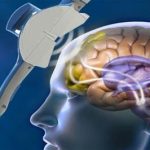 Parkinson: Stimolazione magnetica transcranica migliora i sintomi motori e contrasta le alterazioni dei neuroni striatali