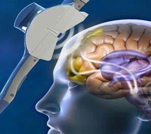 Parkinson: Stimolazione magnetica transcranica migliora i sintomi motori e contrasta le alterazioni dei neuroni striatali
