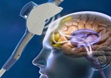 Parkinson: Stimolazione magnetica transcranica migliora i sintomi motori e contrasta le alterazioni dei neuroni striatali