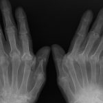 Artrite reumatoide, Baricitinib rallenta la progressione radiografica di malattia rispetto ai farmaci convenzionali e al placebo