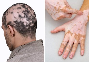 Alopecia e vitiligine: i nuovi orizzonti della fotoprotezione a basso impatto ambientale