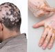 Alopecia e vitiligine: i nuovi orizzonti della fotoprotezione a basso impatto ambientale