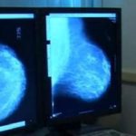 Carcinoma mammario metastatico, ecco le nuove linee guida globali