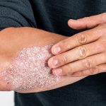 Dermatite atopica e psoriasi: importanti novità sulle terapie