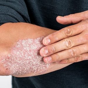 Dermatite atopica e psoriasi: importanti novità sulle terapie