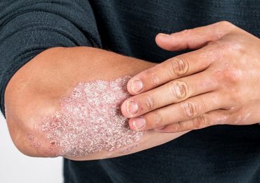 Dermatite atopica e psoriasi: importanti novità sulle terapie