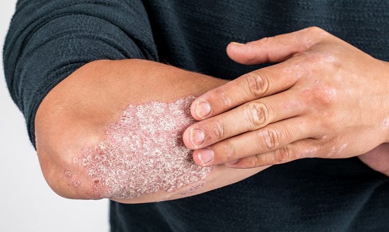 Dermatite atopica e psoriasi: importanti novità sulle terapie