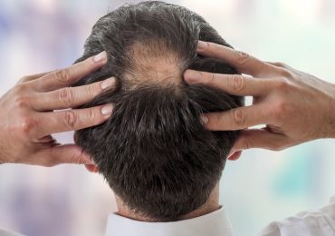 Invecchiamento, nuova ipotesi sulla perdita dei capelli: dipende dalla "fuga" di cellule staminali dal bulbo pilifero