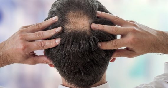 Invecchiamento, nuova ipotesi sulla perdita dei capelli: dipende dalla "fuga" di cellule staminali dal bulbo pilifero