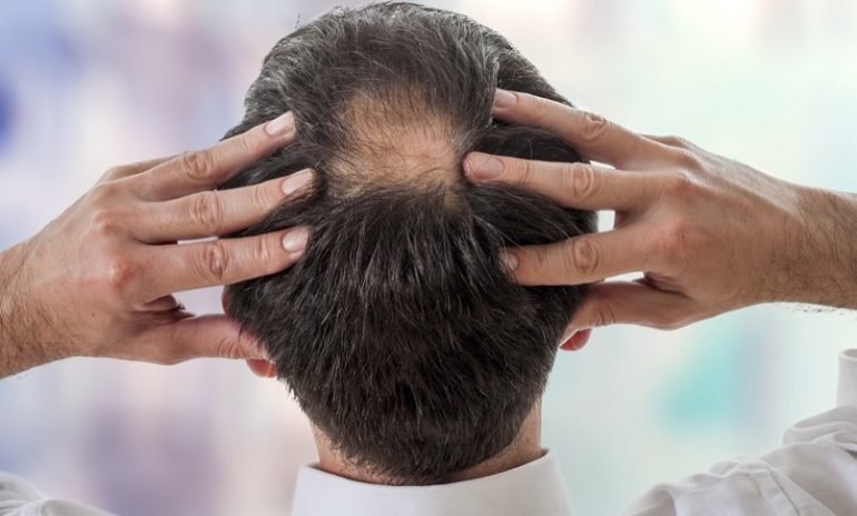 Invecchiamento, nuova ipotesi sulla perdita dei capelli: dipende dalla "fuga" di cellule staminali dal bulbo pilifero