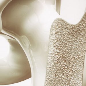 Osteoporosi: nuovo esame diagnostico al mondo per valutare la struttura dell'osso