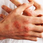 Psoriasi, identificati i fattori di rischio che ne favoriscono la comparsa