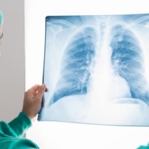 Tumore al polmone: nuovi test per valutazione simultanea di alterazioni genetiche
