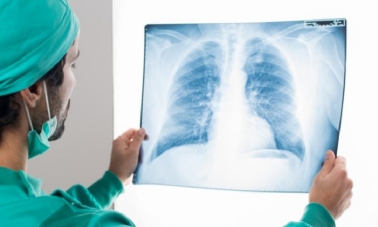 Tumore al polmone: nuovi test per valutazione simultanea di alterazioni genetiche