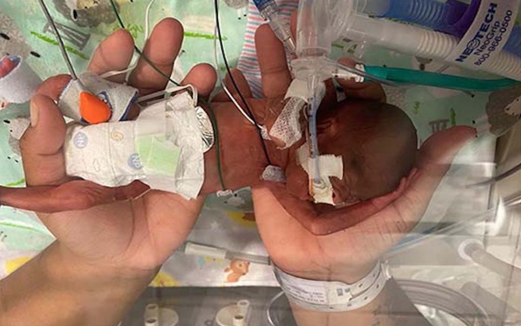 Compie 16 mesi il neonato più prematuro al mondo. Nato alla 21º settimana di gestazione, pesava 420 grammi