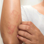 Dermatite atopica: sollievo prolungato grazie ad asivatrep in crema