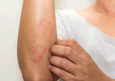 Dermatite atopica: sollievo prolungato grazie ad asivatrep in crema