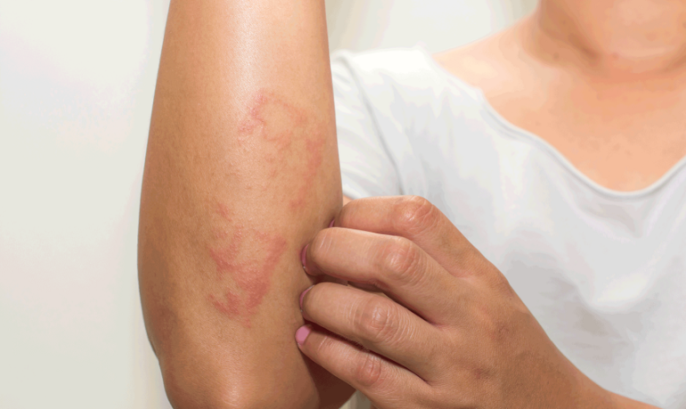 Dermatite atopica: sollievo prolungato grazie ad asivatrep in crema