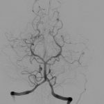 Innovativo intervento di aneurisma cerebrale nella ASL BAT, primo al Sud 3