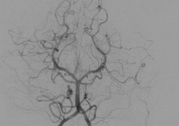 Innovativo intervento di aneurisma cerebrale nella ASL BAT, primo al Sud 3