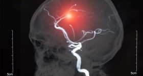 L’aneurisma cerebrale: sintomi, diagnosi, prevenzione e cura