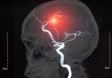 L’aneurisma cerebrale: sintomi, diagnosi, prevenzione e cura