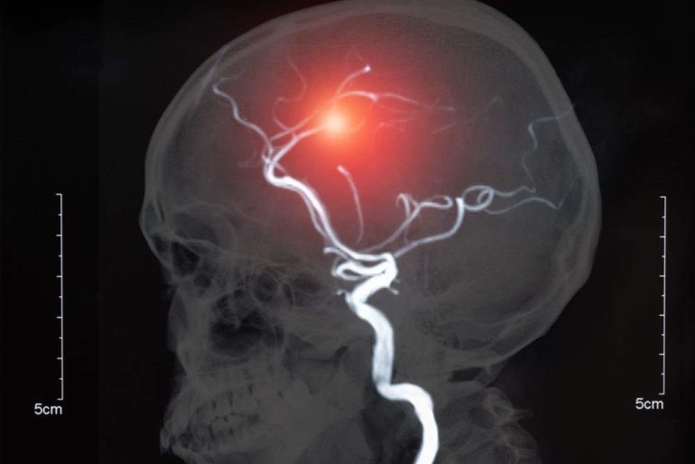 L’aneurisma cerebrale: sintomi, diagnosi, prevenzione e cura