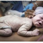 Delayed Umbilical Cord Clamping (DCC): il ritardato clampaggio del cordone ombelicale