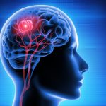 Glioblastoma: una speranza dal vaccino autologo con cellule dendritiche