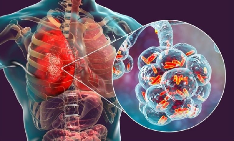 Polmonite batterica, sperimentato test super rapido: risultati in meno di due ore