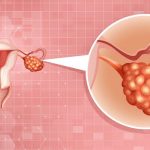 Carcinoma ovarico: i benefici del PARP-inibitore rucaparib