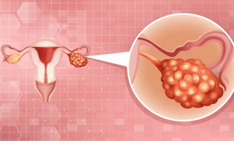 Carcinoma ovarico: i benefici del PARP-inibitore rucaparib