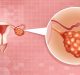 Carcinoma ovarico: i benefici del PARP-inibitore rucaparib