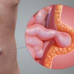 Ernia ombelicale: conosciamola meglio