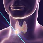 Nodulo tiroideo: come accorgersi della sua presenza?