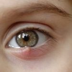 Orzaiolo e Calazio, cosa sono, come riconoscerli, prevenzione, come si curano 1