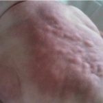 Adiponecrosi sottocutanea nel neonato: diagnosi, complicanze, prognosi e terapia